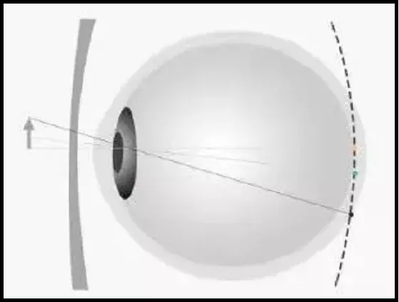 How to prevent and control myopia? Comprehensive comparison of frame mirror, OK mirror, and defocus mirror!