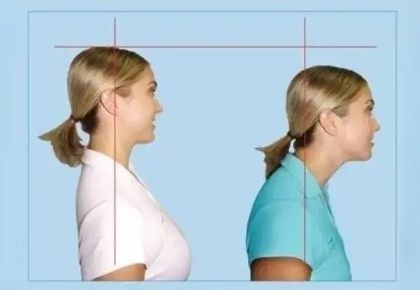 After practicing ‘Swan Neck’ for a month, my neck has tilted forward even more!